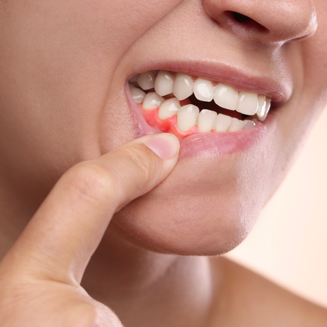 One More Harmful Effect of Smoking You Probably Didn’t Think About: Gum Disease